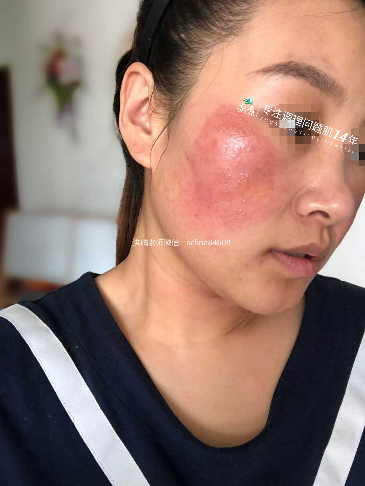 七老激素脸红肿烫痒疹子疙瘩渗液结痂修护案例