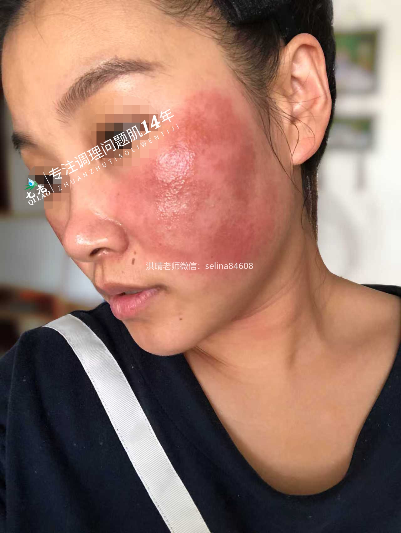 七老激素脸红肿烫痒疹子疙瘩渗液结痂修护案例