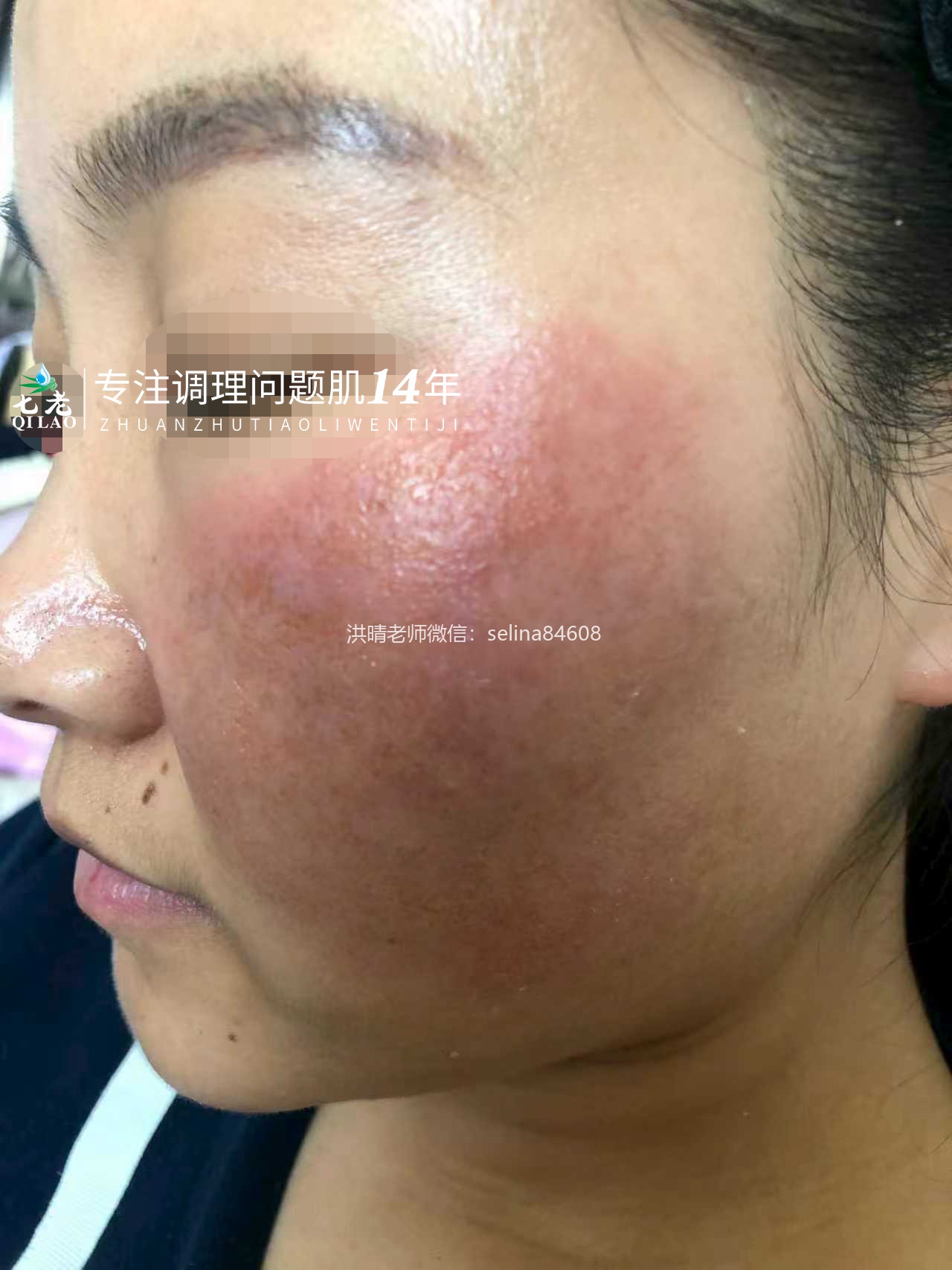 七老激素脸红肿烫痒疹子疙瘩渗液结痂修护案例