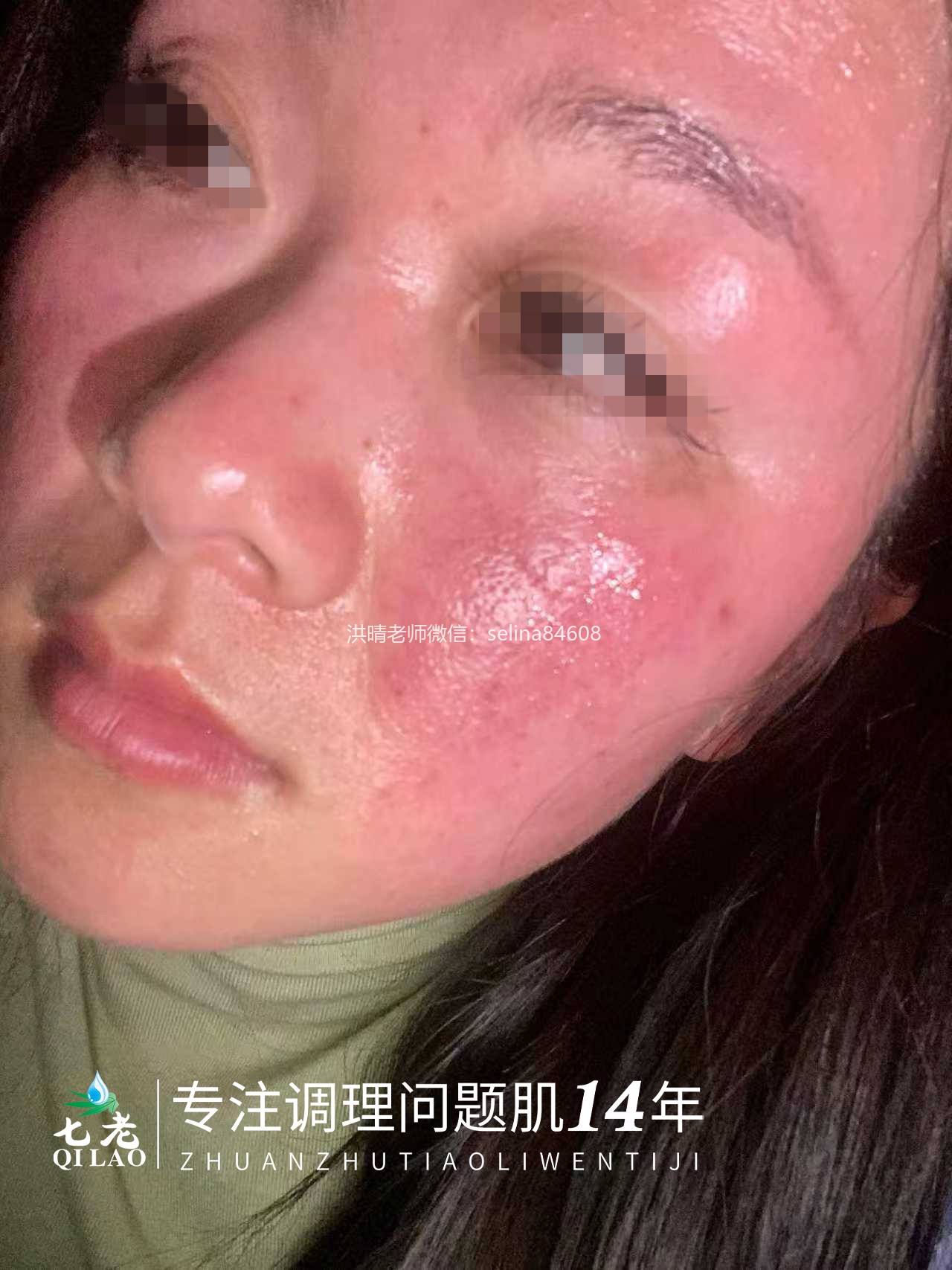 七老激素脸玫瑰➕脂溢性皮炎修护案例