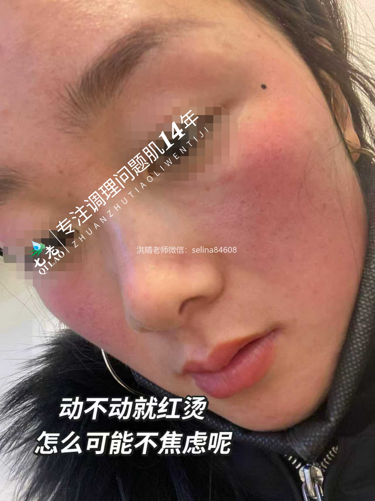 七老激素脸玫瑰➕脂溢性皮炎修护案例