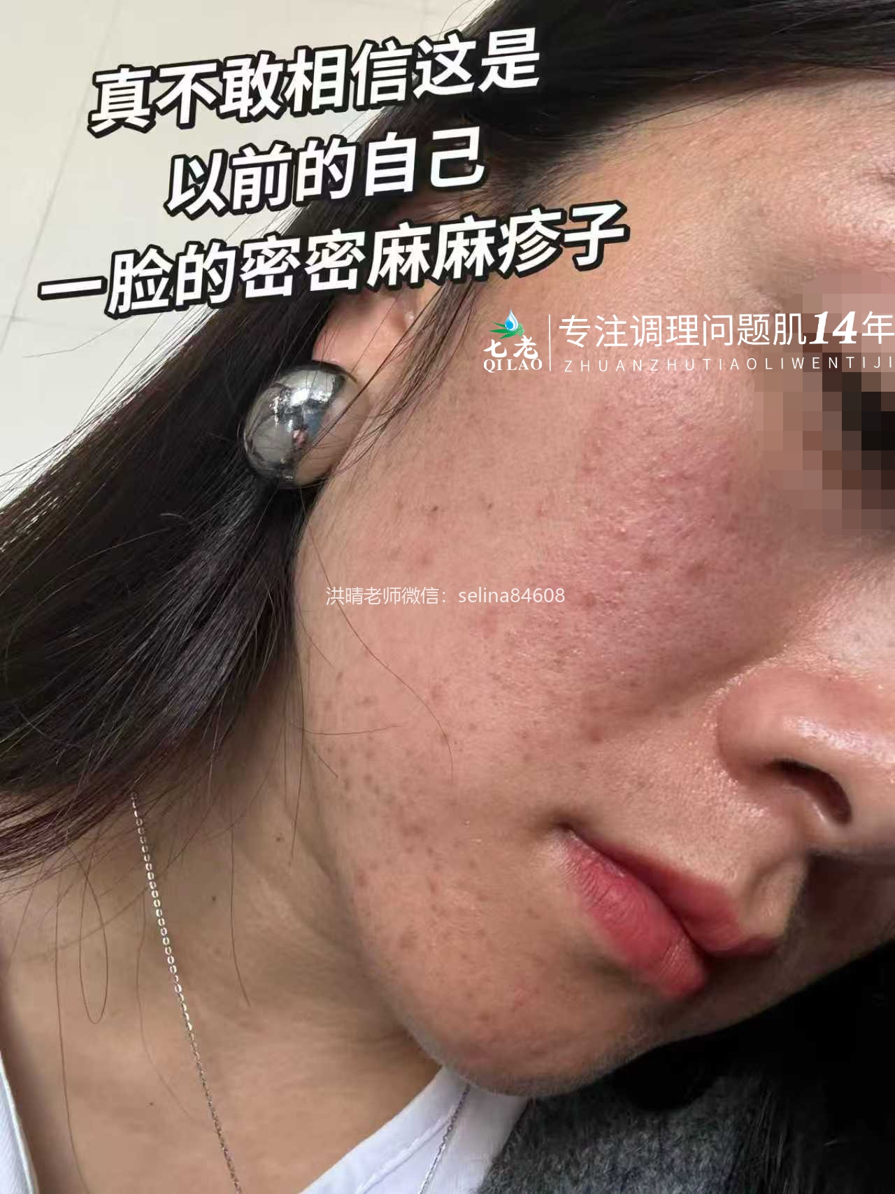 七老激素脸玫瑰➕脂溢性皮炎修护案例