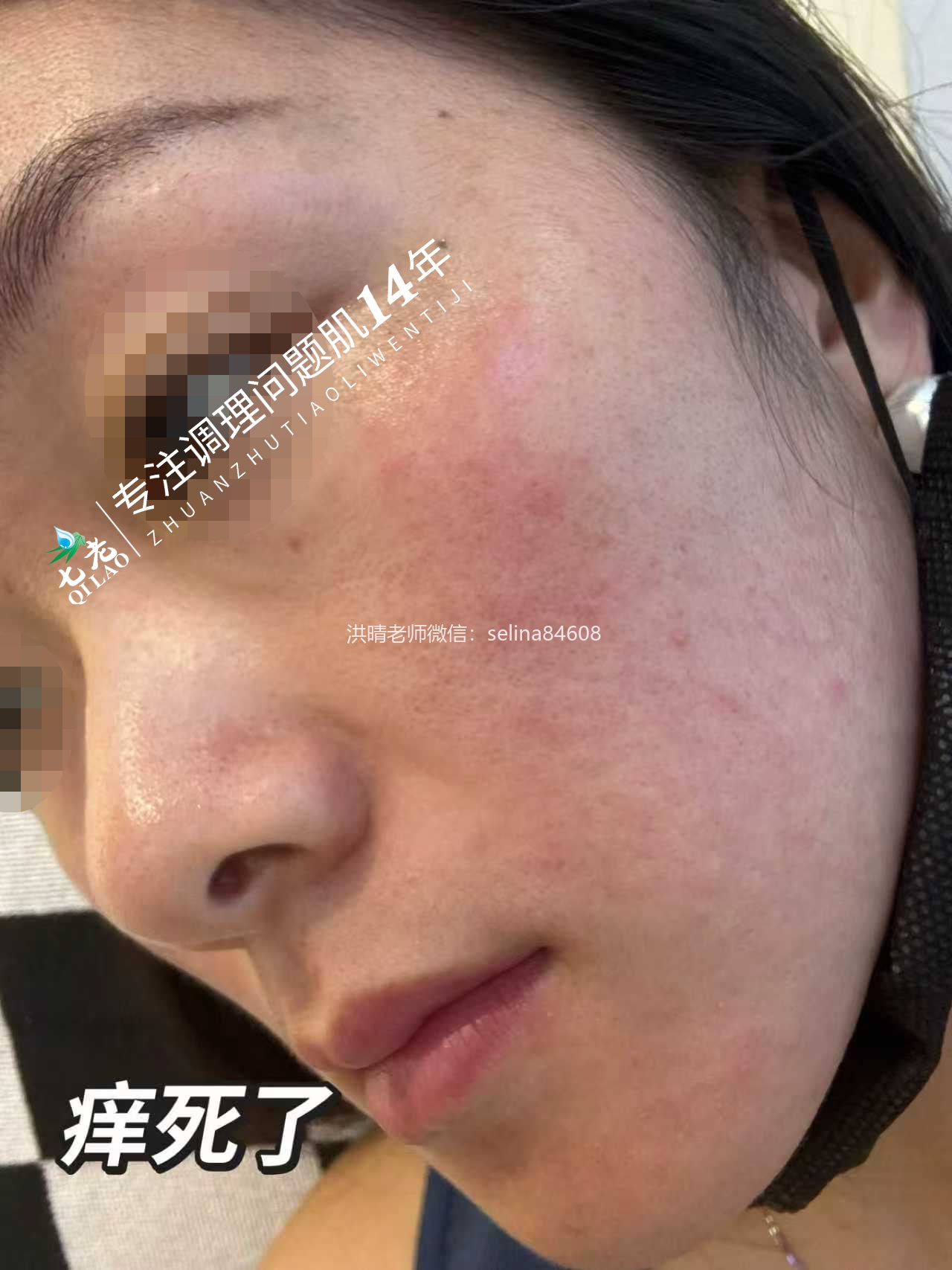 七老激素脸玫瑰➕脂溢性皮炎修护案例