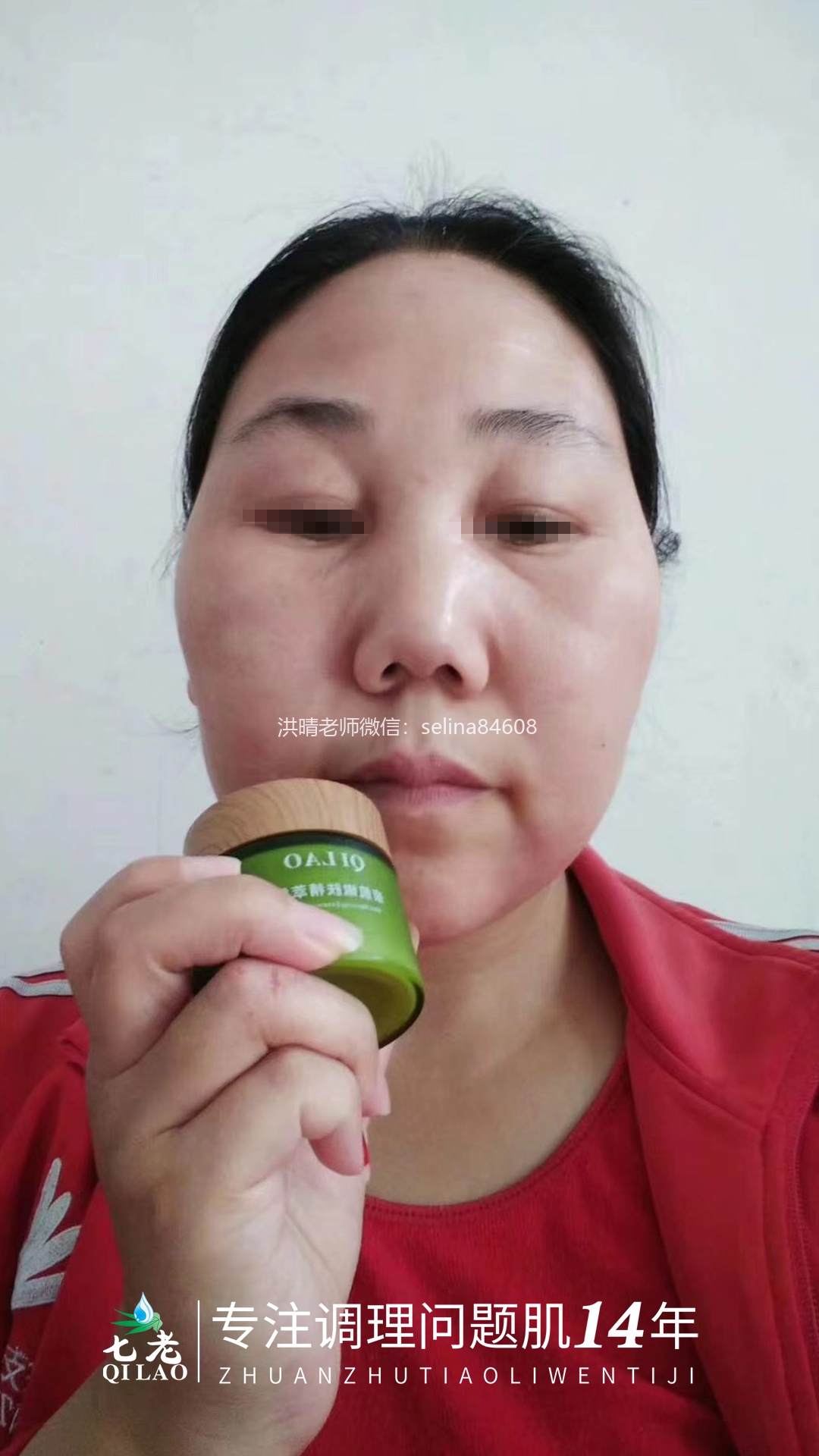 七老激素脸修护案例