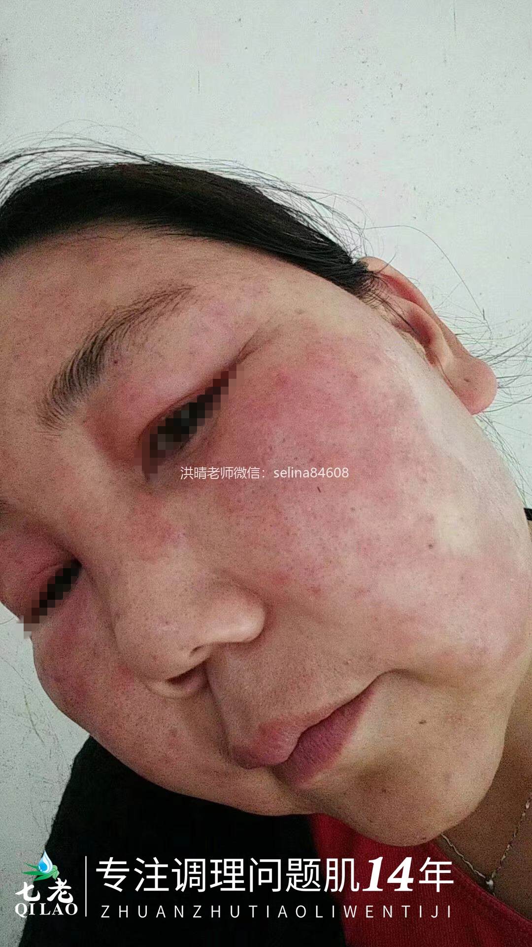 七老激素脸修护案例