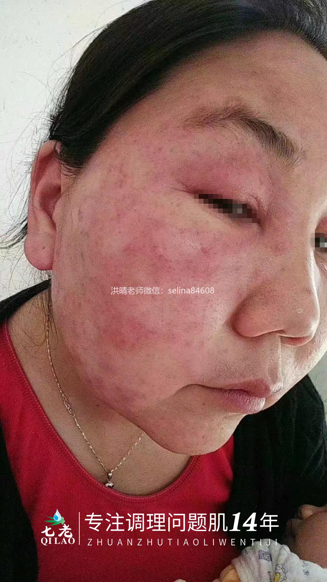 七老激素脸修护案例