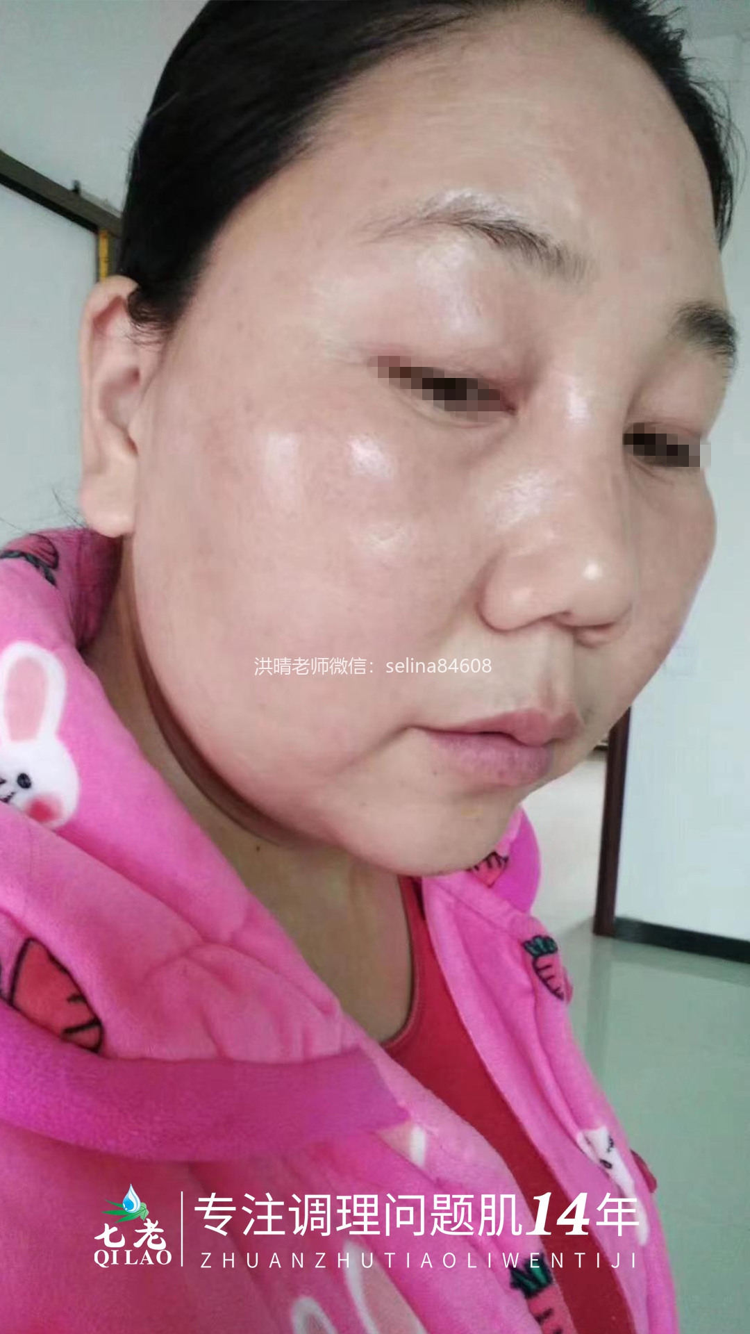 七老激素脸修护案例