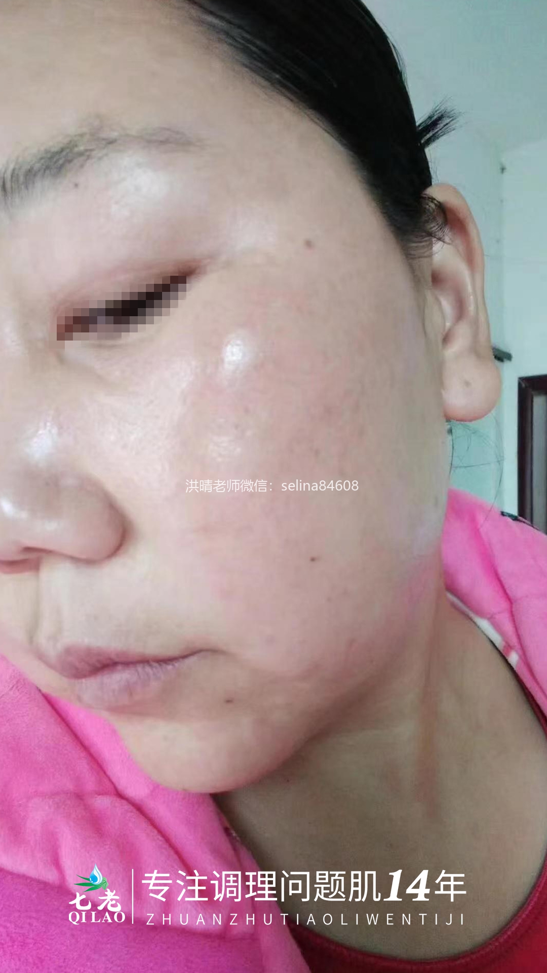 七老激素脸修护案例