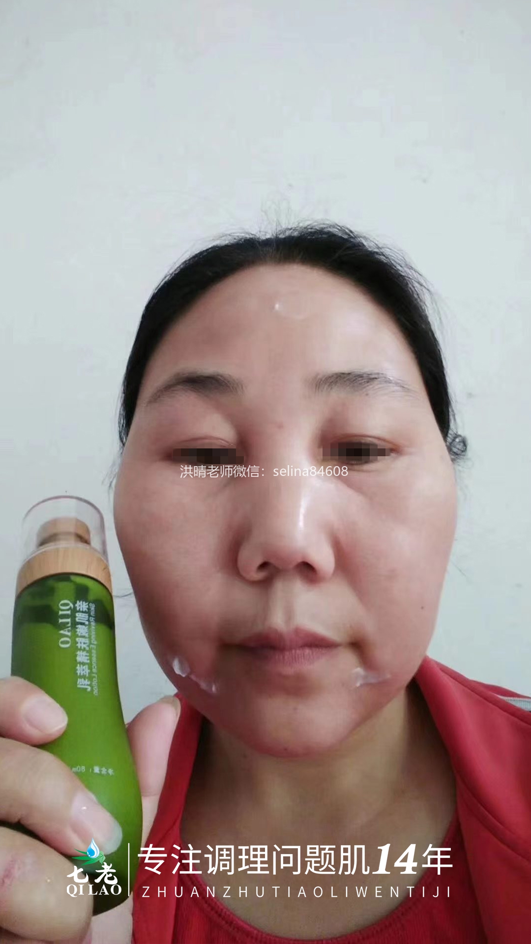 七老激素脸修护案例