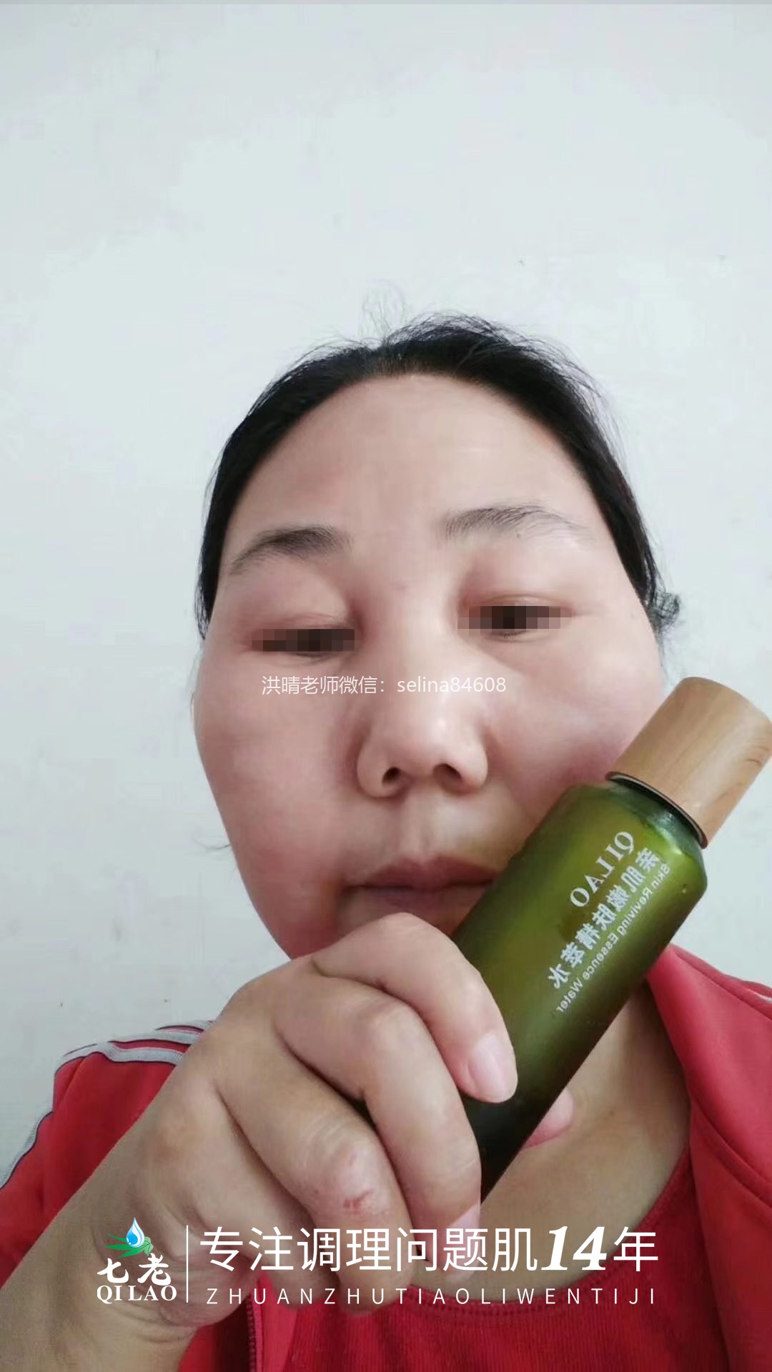 七老激素脸修护案例