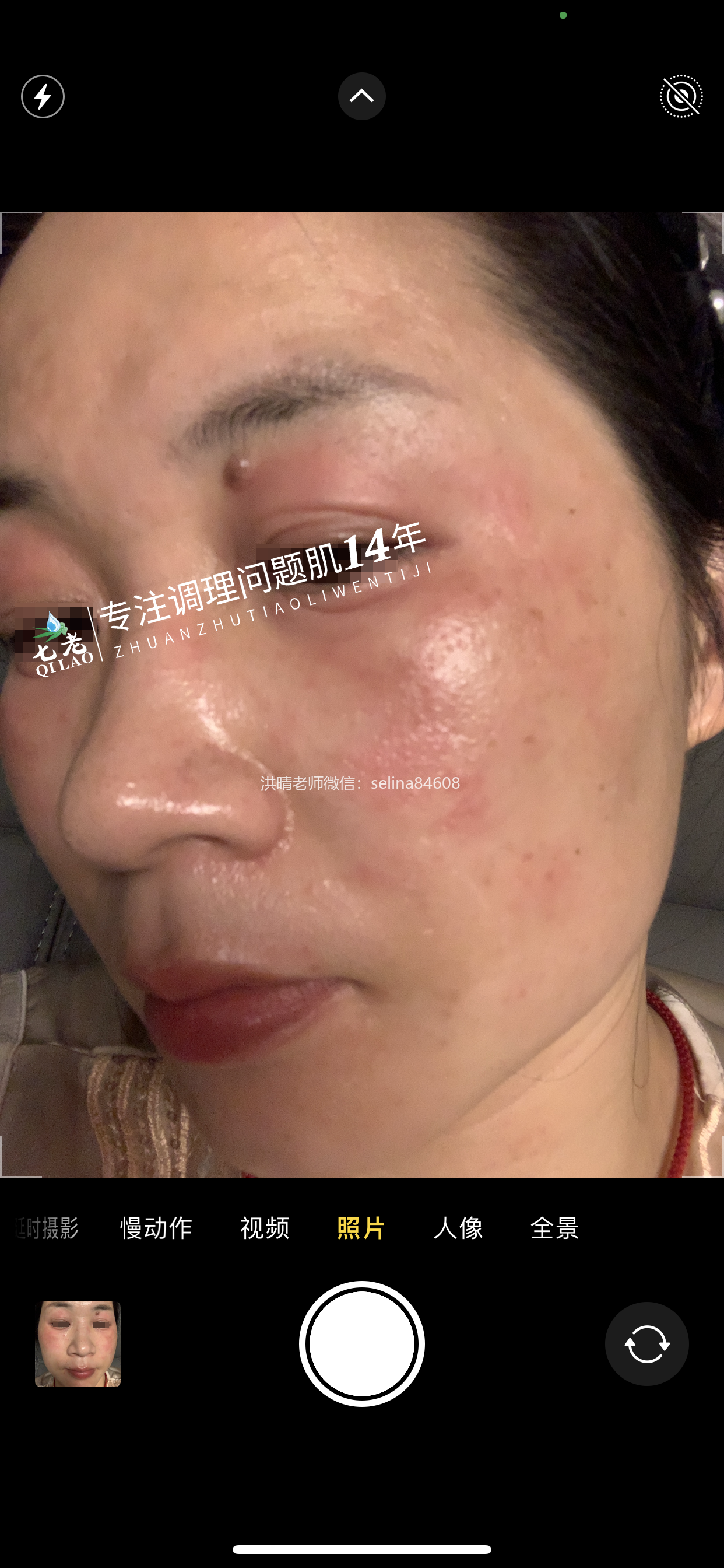 七老眼周反复过敏案例