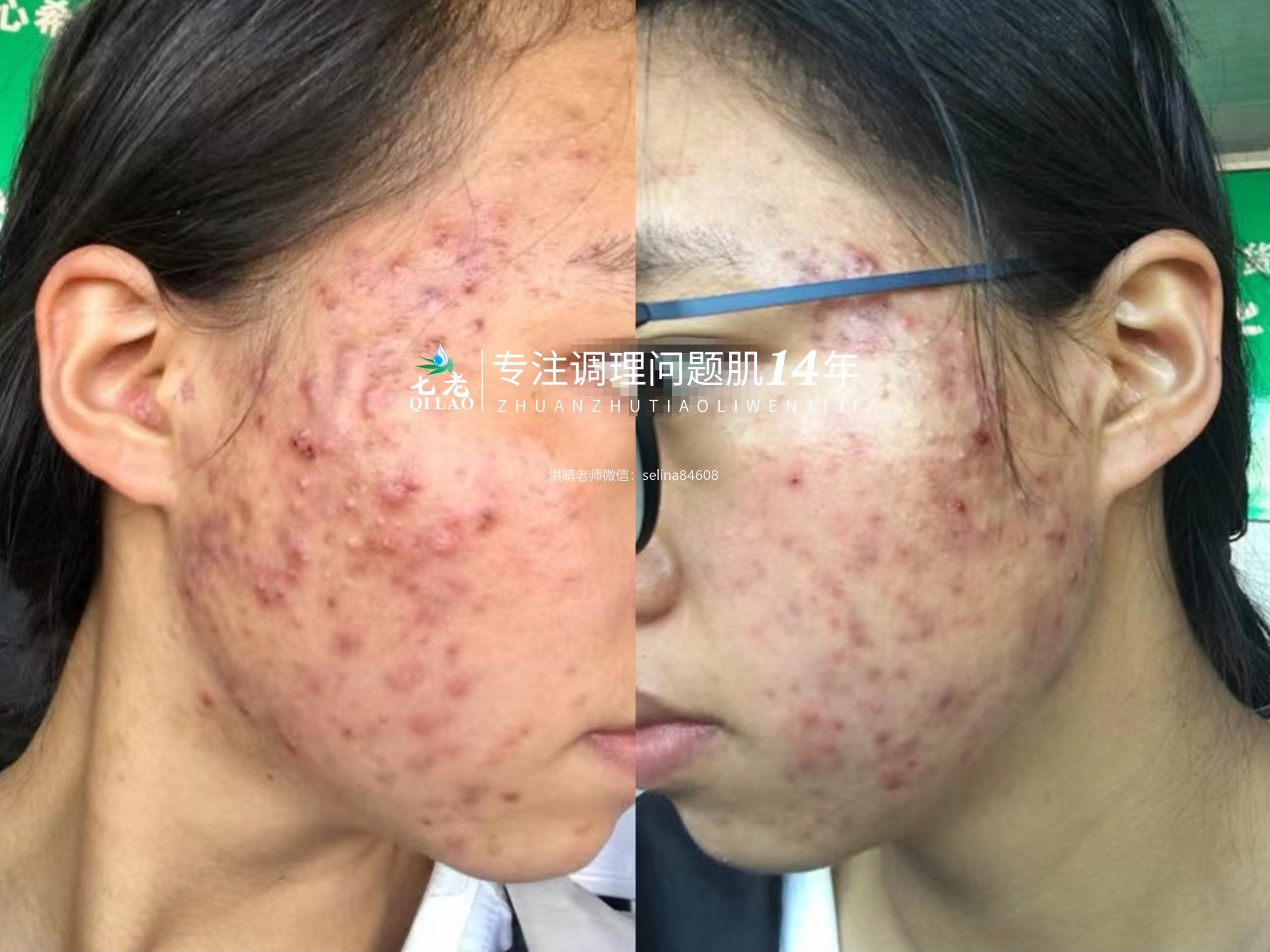 七老严重激素脸激素痘修护案例