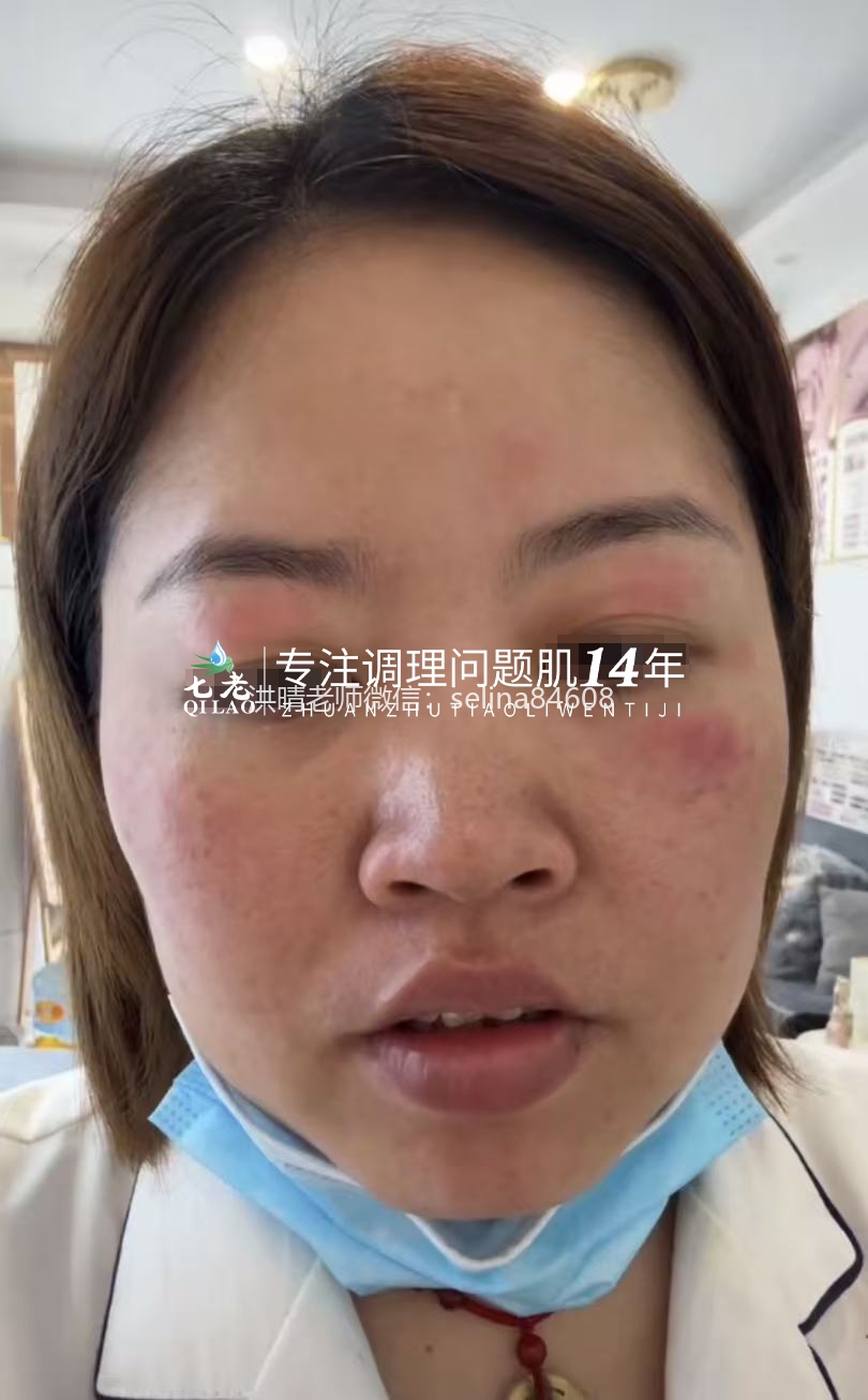七老激素脸红肿痒反复过敏修护案例