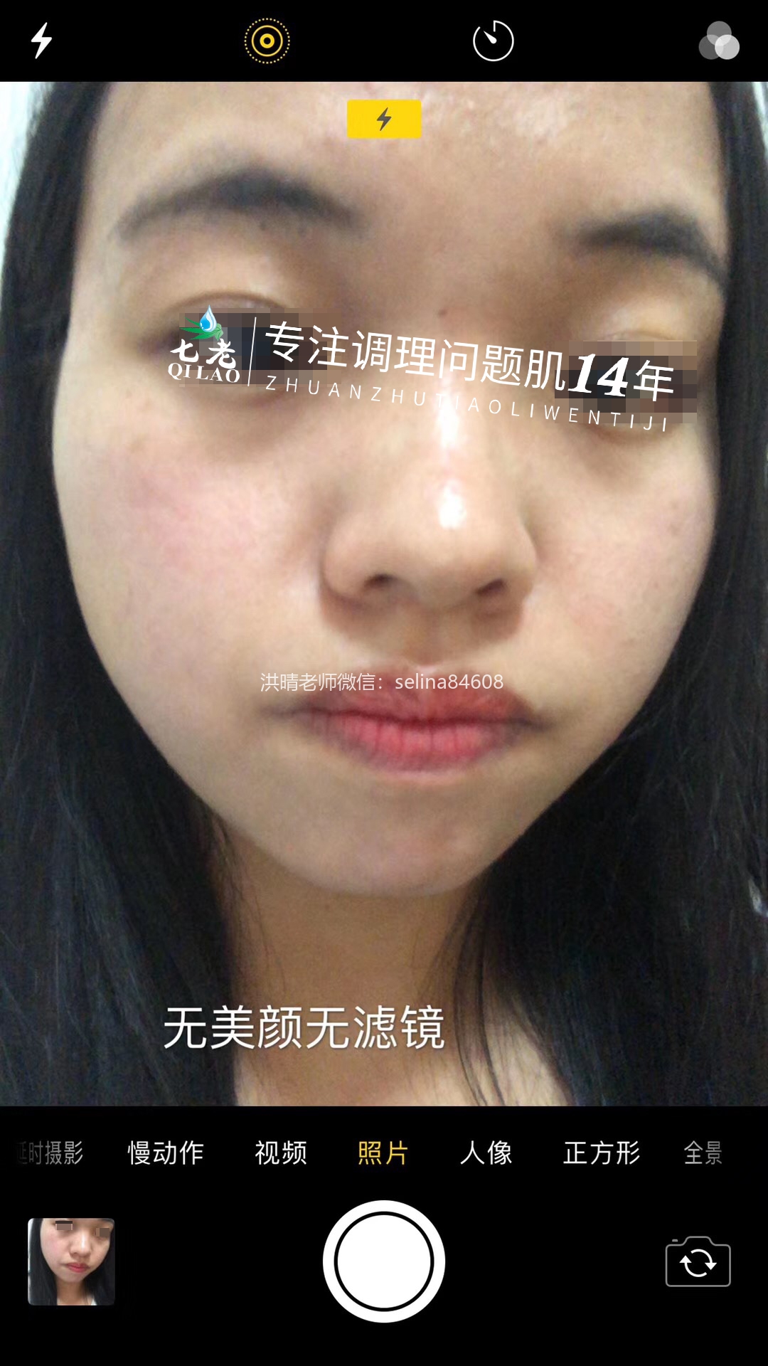 七老严重激素脸激素痘修护案例