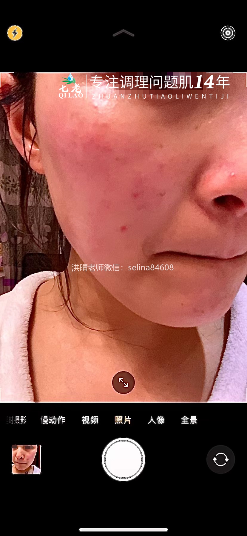 七老屏障受损剥脱祛斑敏感发红修护案例