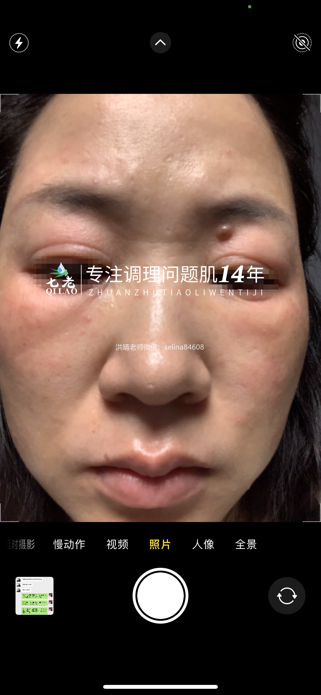 七老眼周反复过敏案例