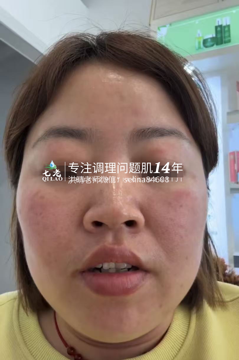 七老激素脸红肿痒反复过敏修护案例