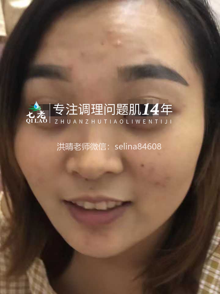 七老屏障受损反复敏感长痘修护案例