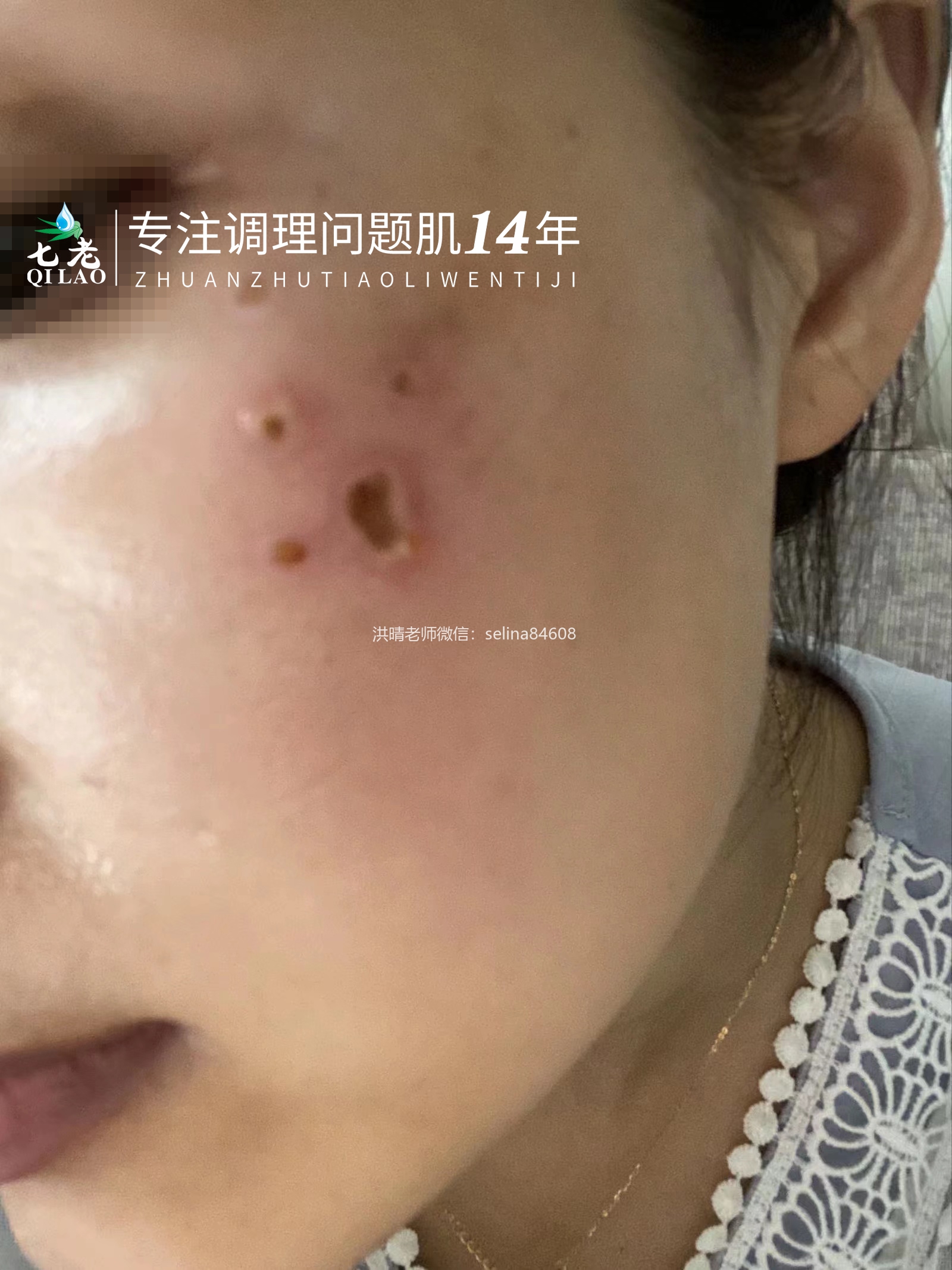 七老屏障受损剥脱祛斑敏感发红修护案例