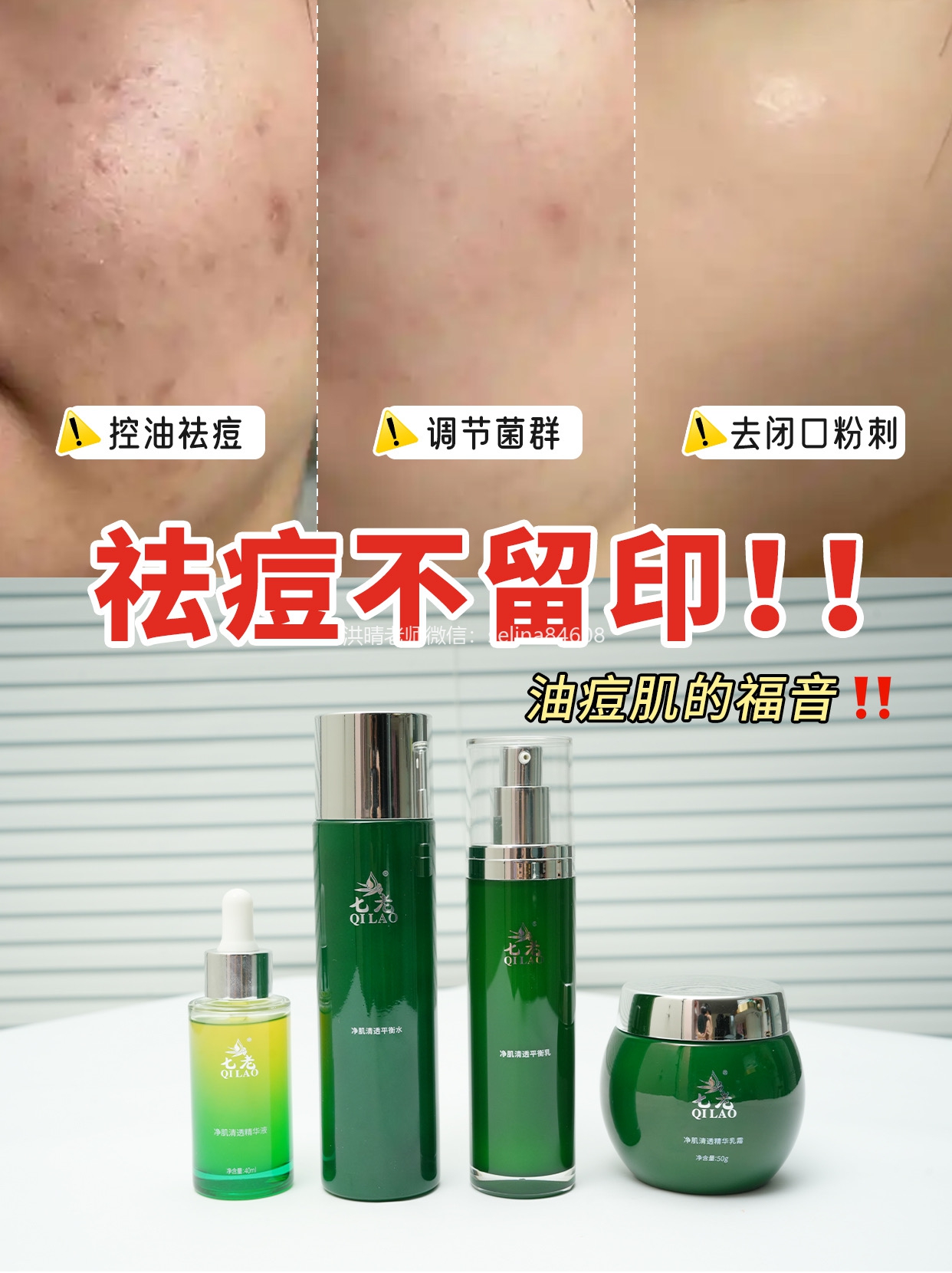 春季烂脸祛痘指南