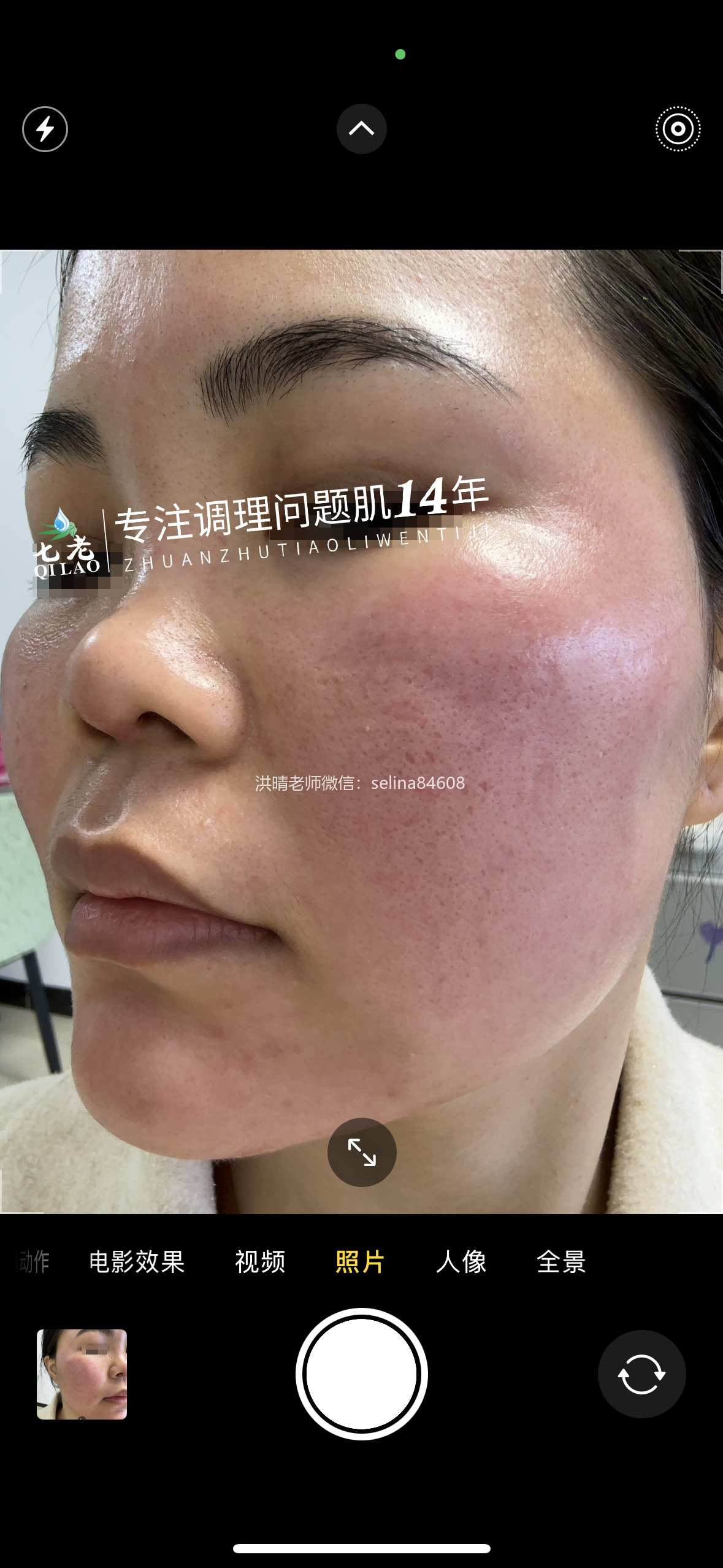 七老发红发烫大红脸红黑脸修护案例