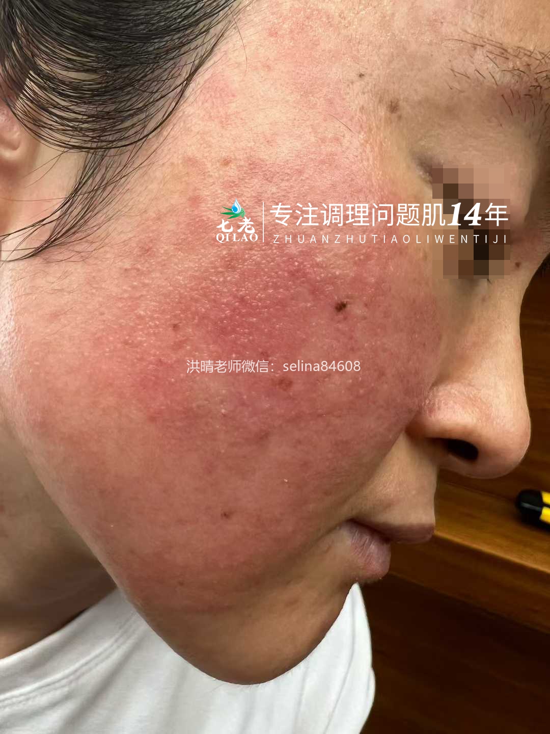 七老激素脸脂溢性皮炎修复案例