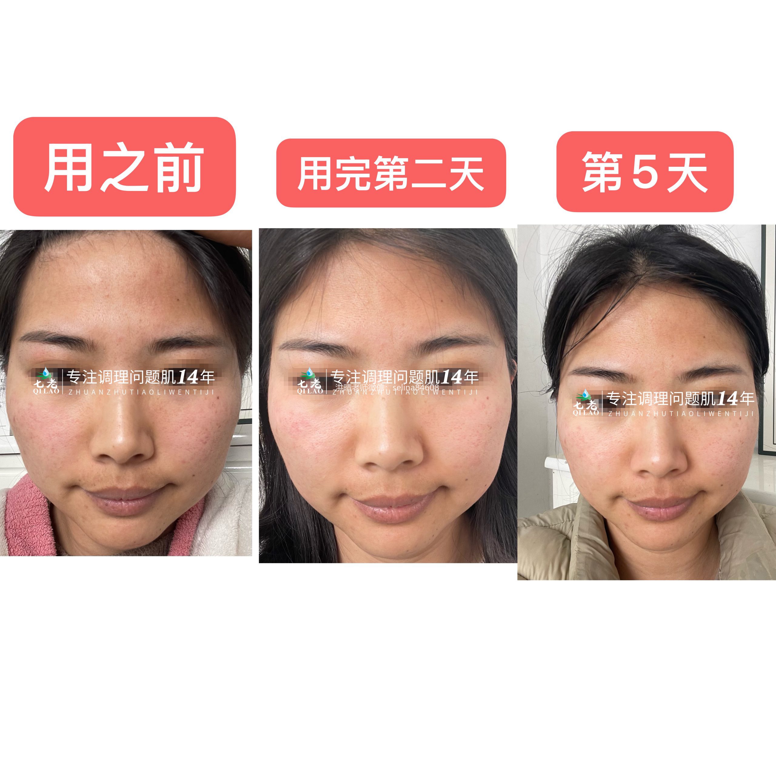 七老胶原水光五天的前后对比🆚