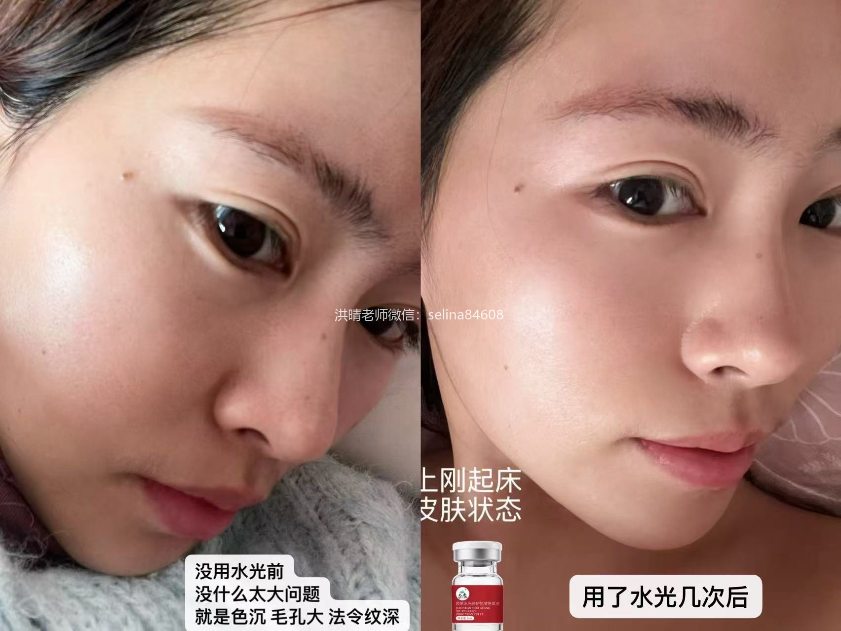 七老胶原水光用前用后对比图