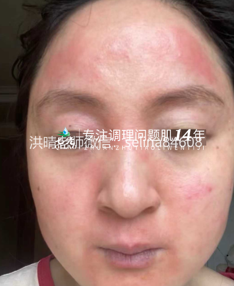 七老激素脸脂溢性皮炎修复案例