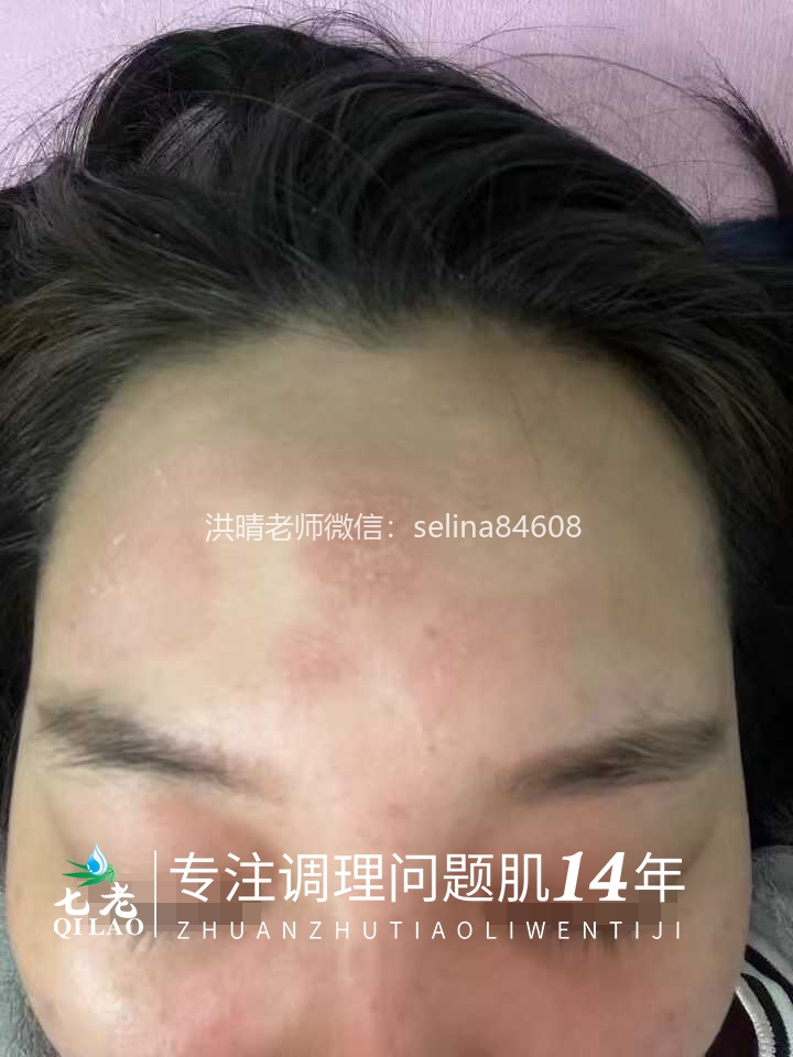 七老屏障受损反复敏感长痘修护案例