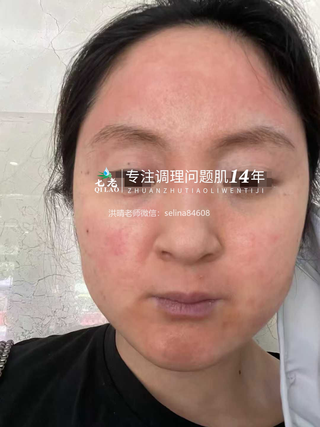 七老激素脸脂溢性皮炎修复案例