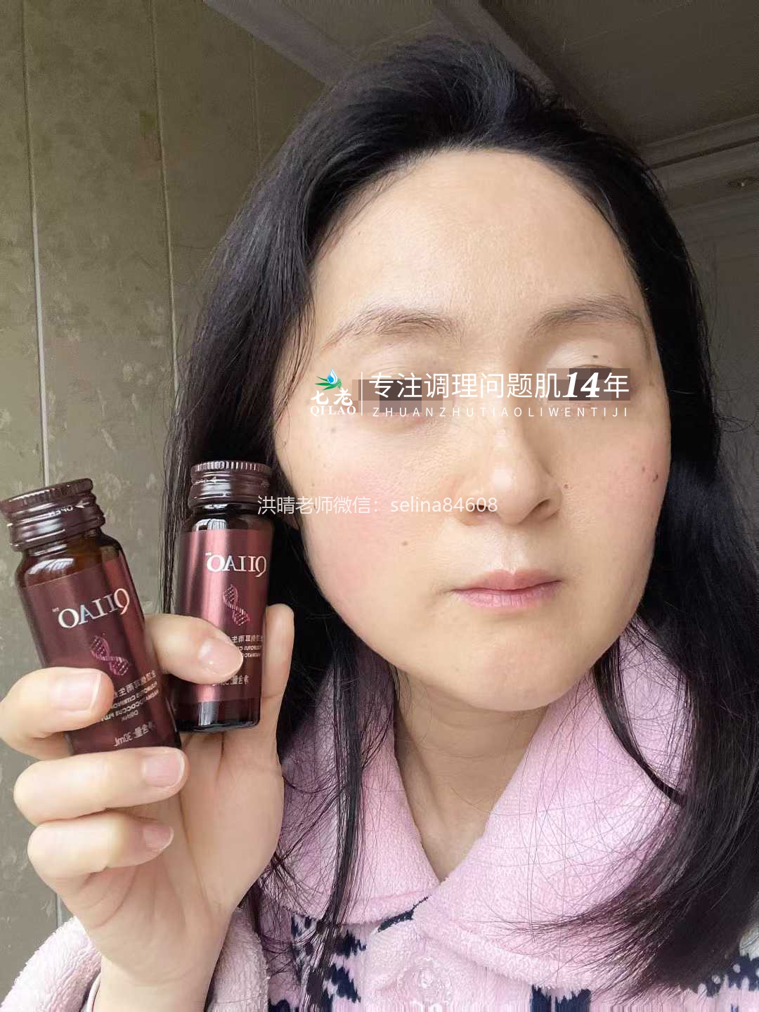 七老激素脸脂溢性皮炎修复案例