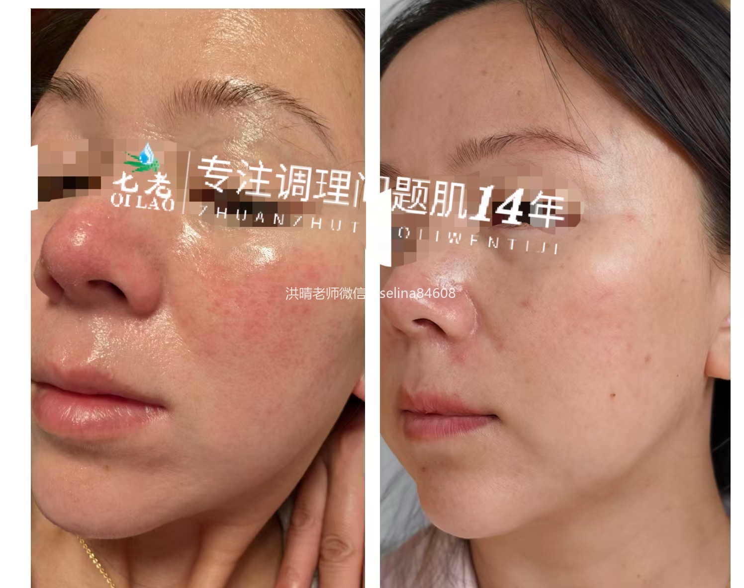 七老胶原水光修护案例反馈