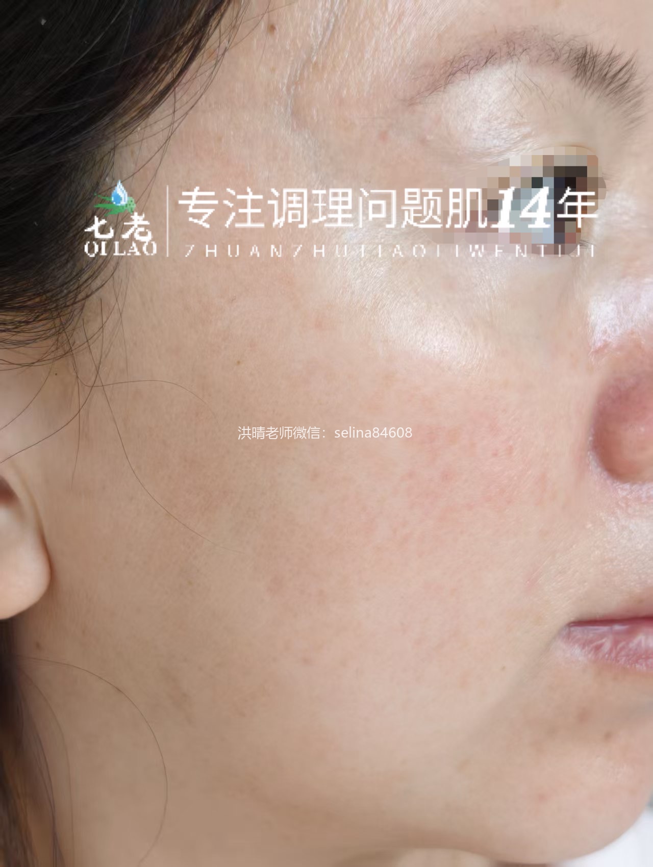 七老胶原水光修护案例反馈