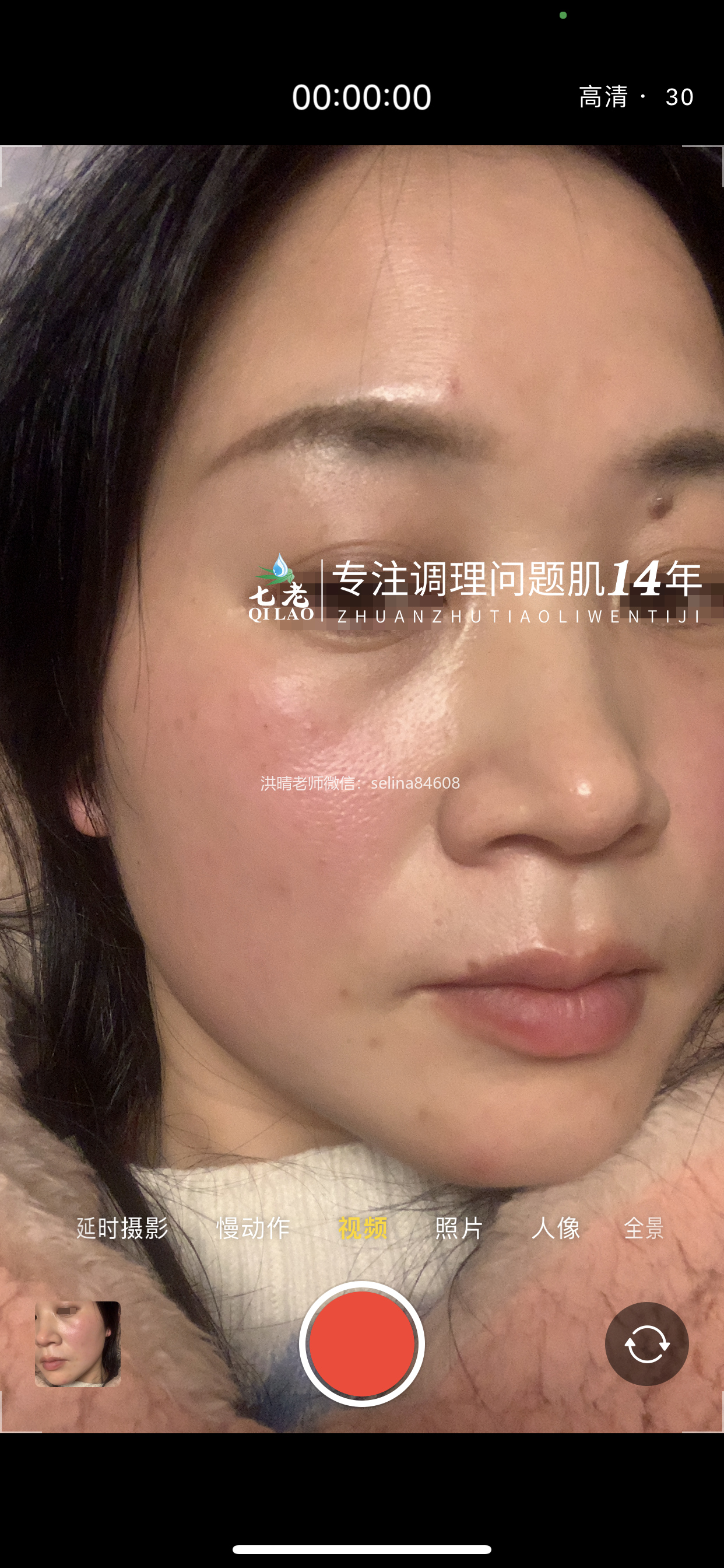 七老眼周反复过敏案例