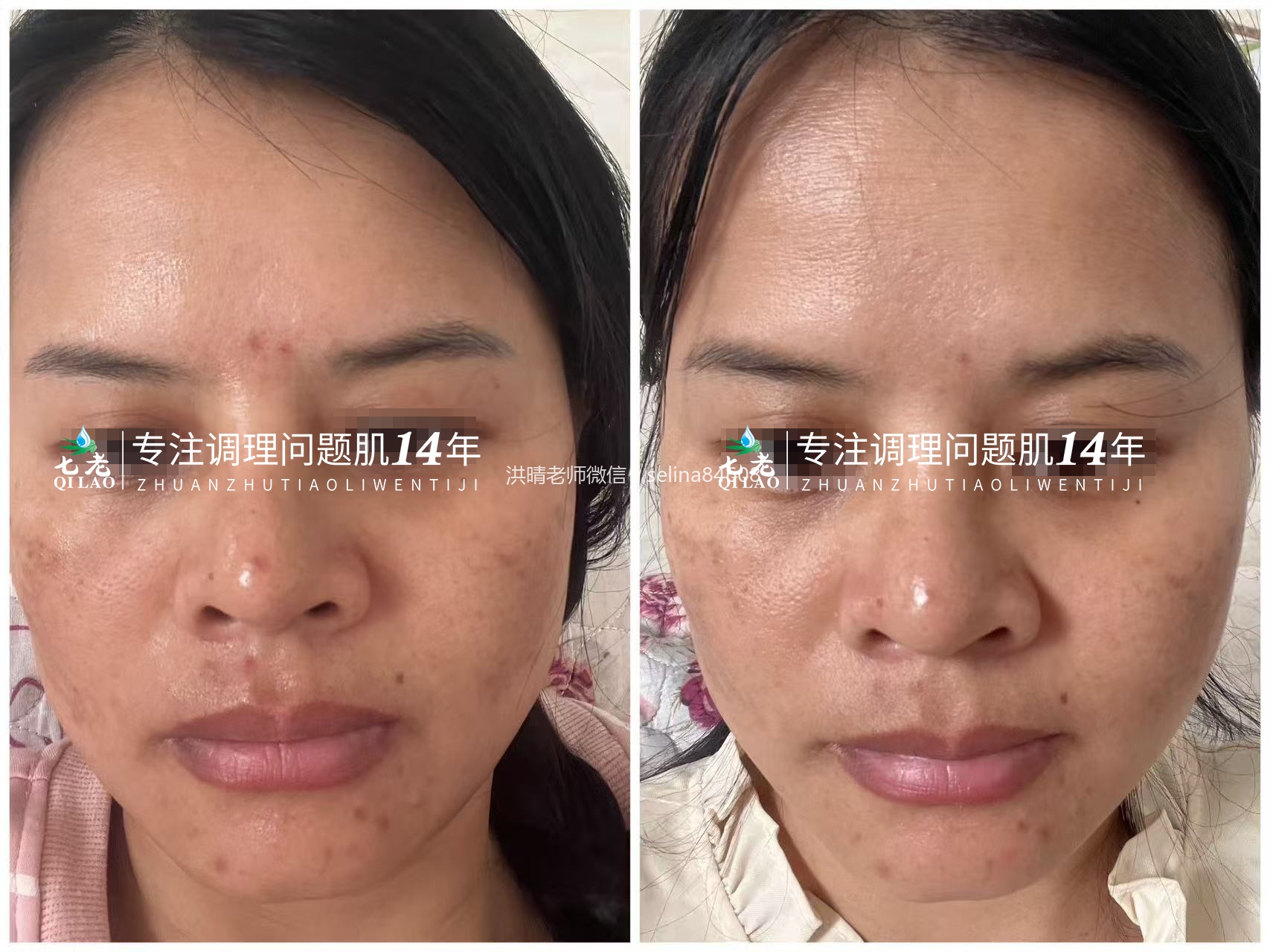 七老四重肽胶原蛋白，胶原直补，水润紧致饱满抗衰老绝绝子