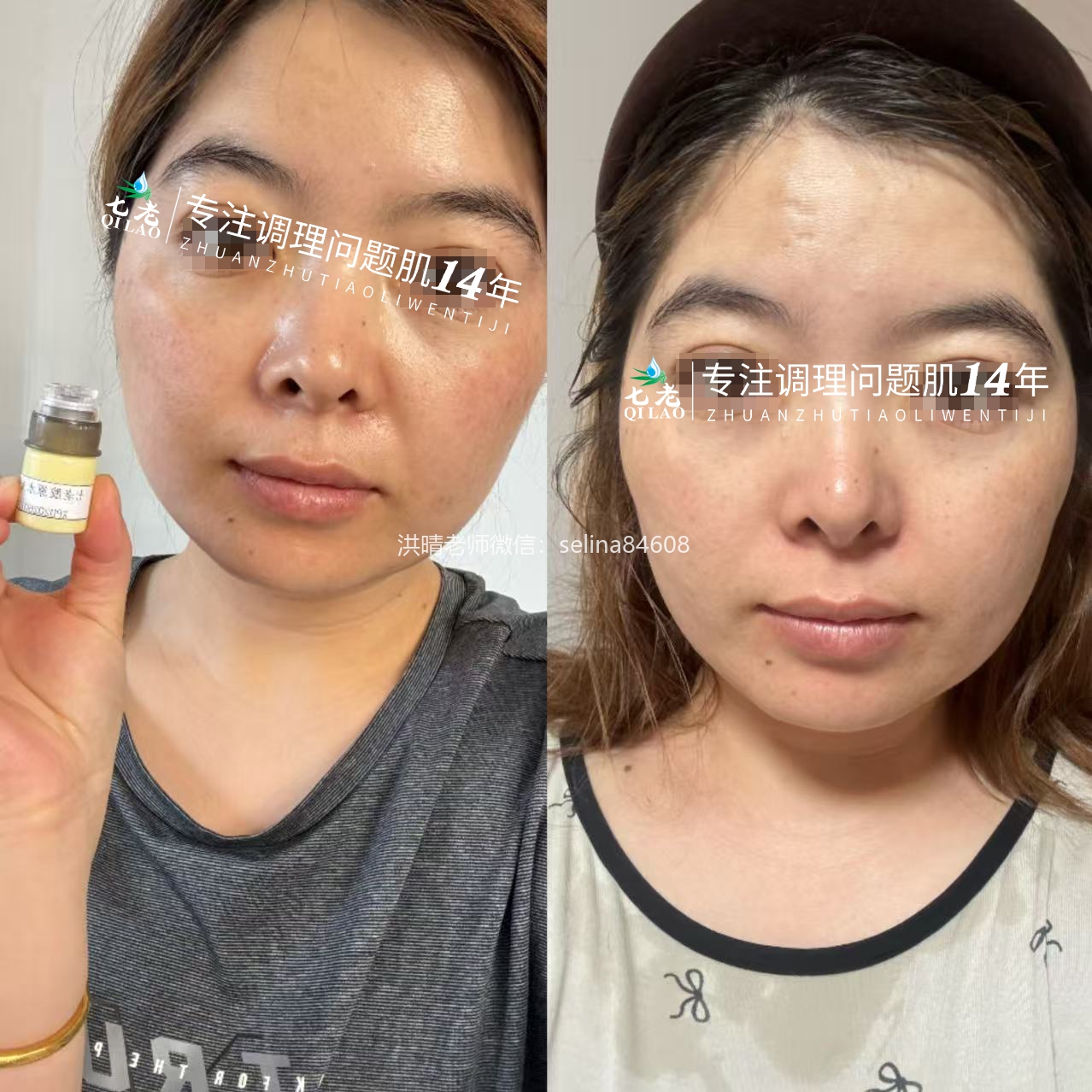 七老胶原修护水光→急性火症期也能用