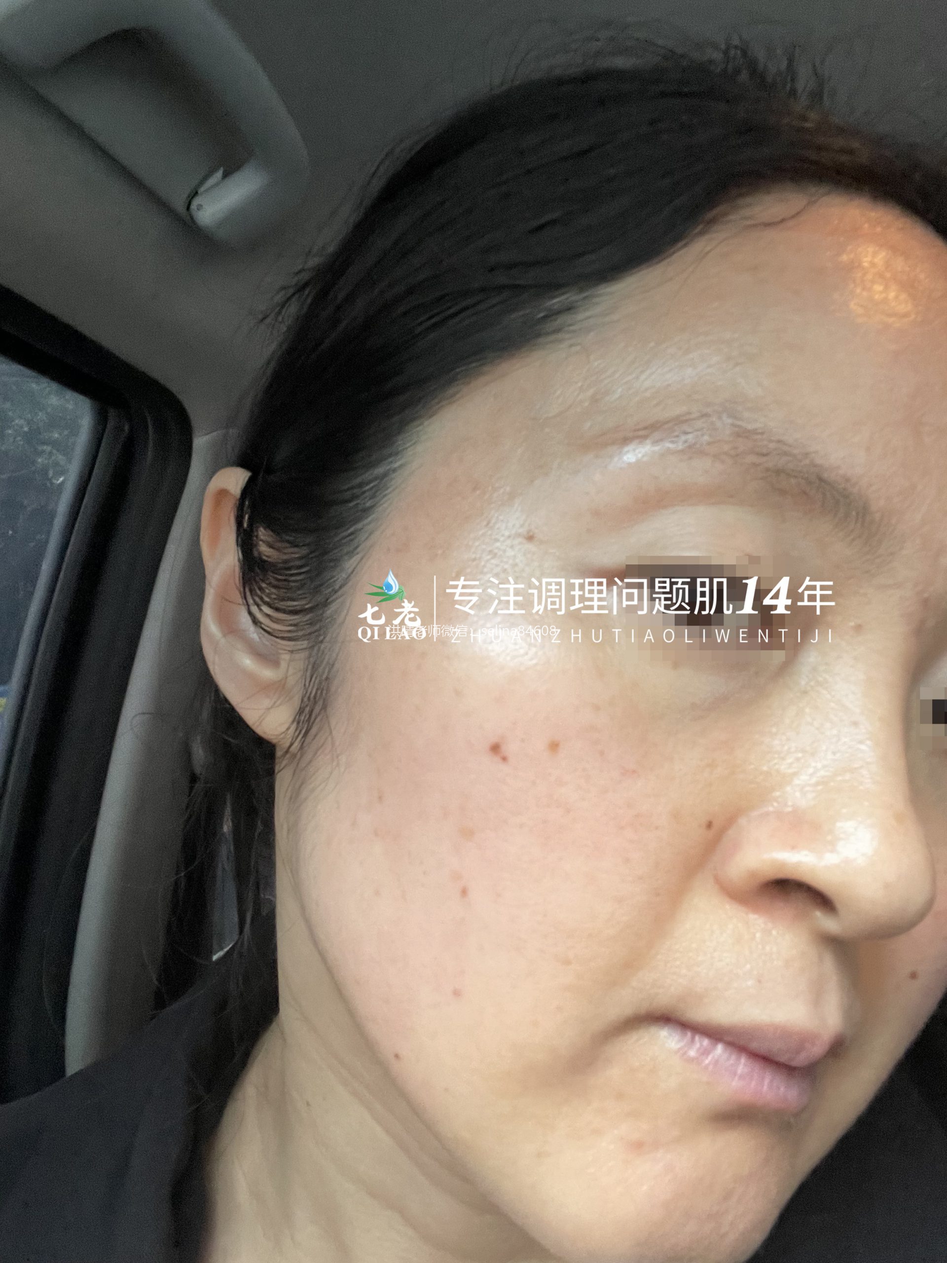 七老激素脸脂溢性皮炎修复案例