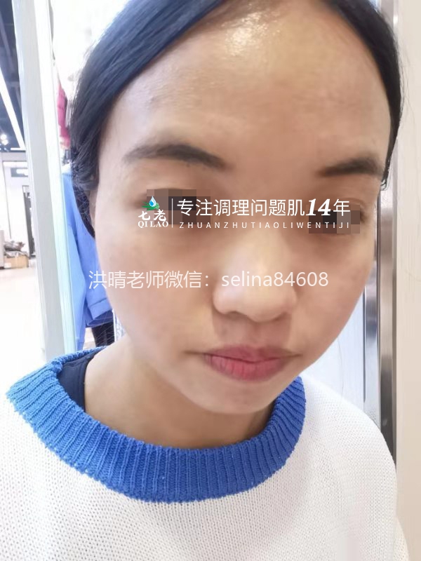 七老严重激素脸激素痘修护案例