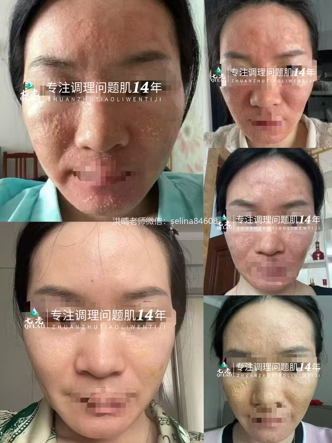 七老激素脸干红痒疹子渗液流黄水结痂修护案例