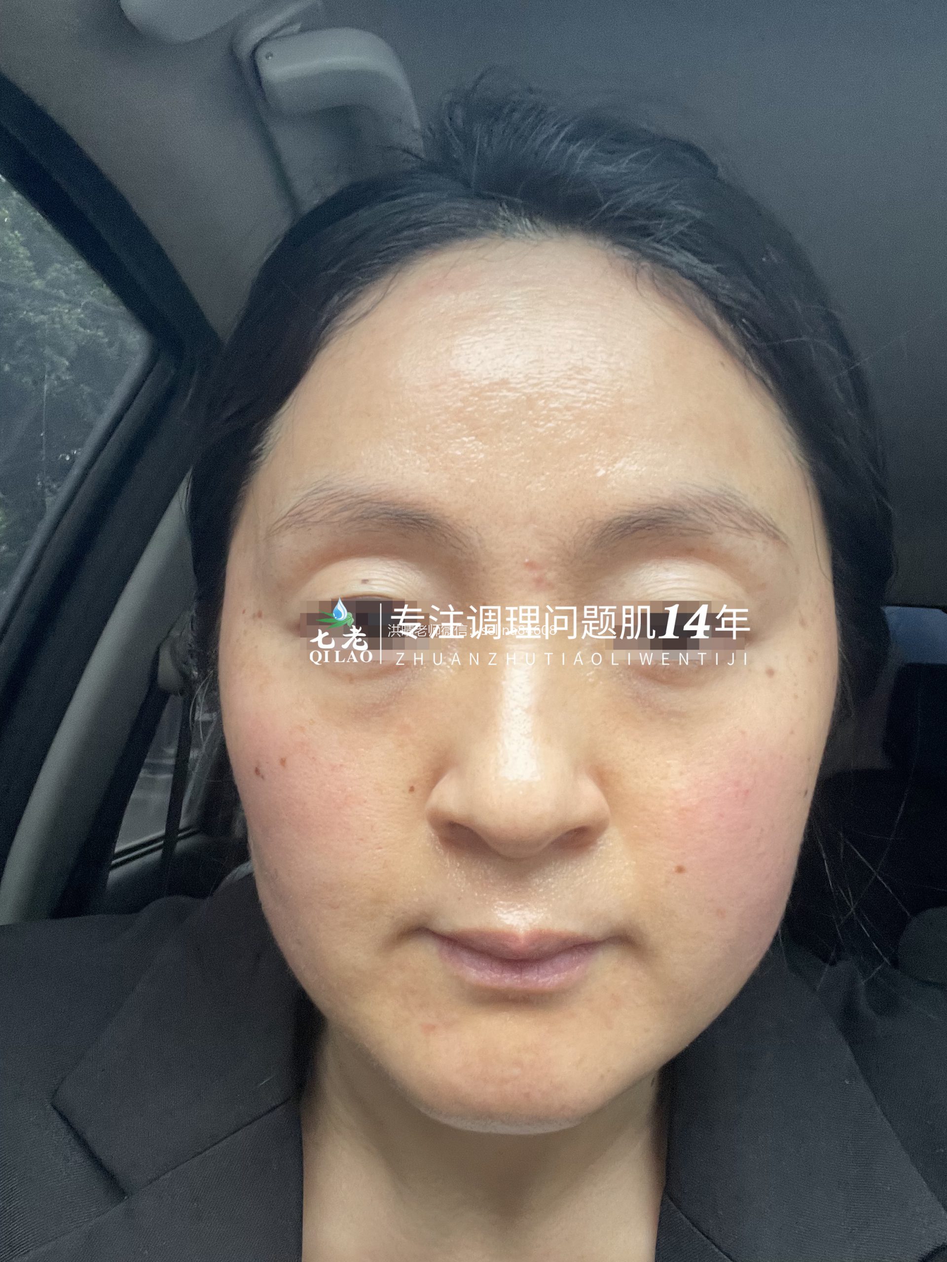 七老激素脸脂溢性皮炎修复案例