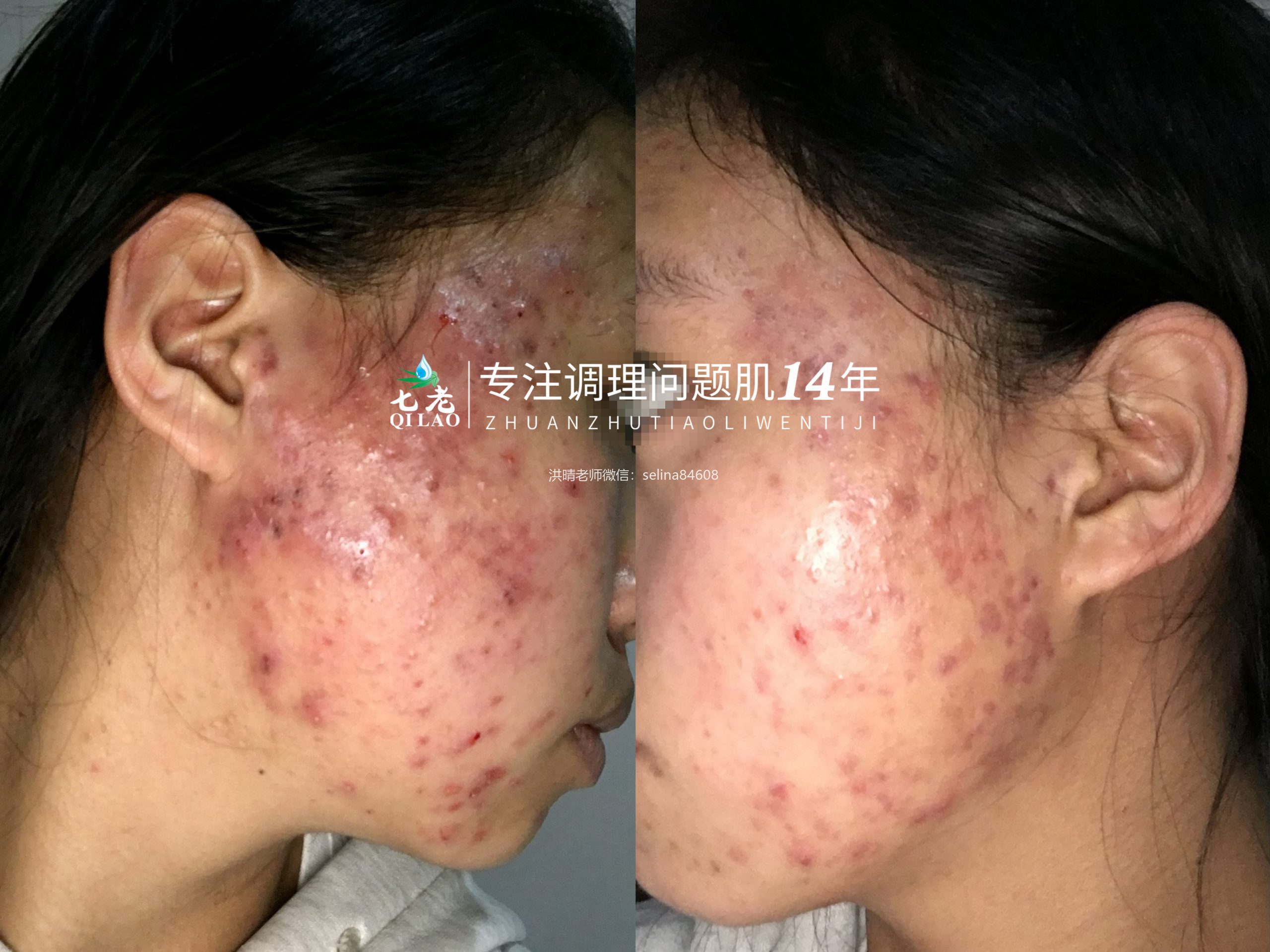 七老严重激素脸激素痘修护案例