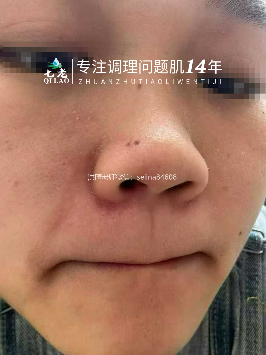 七老脂溢性皮炎修护传明酸反馈