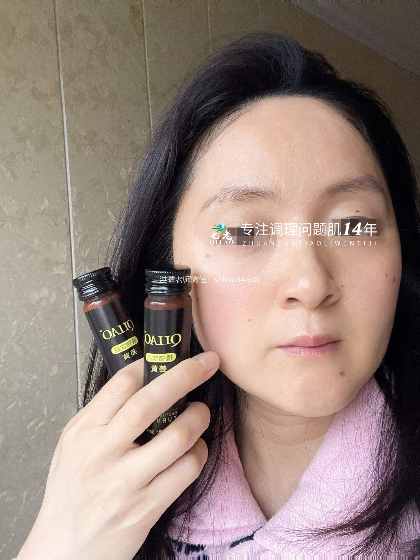 七老激素脸脂溢性皮炎修复案例