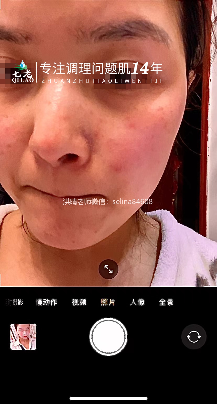 七老屏障受损剥脱祛斑敏感发红修护案例