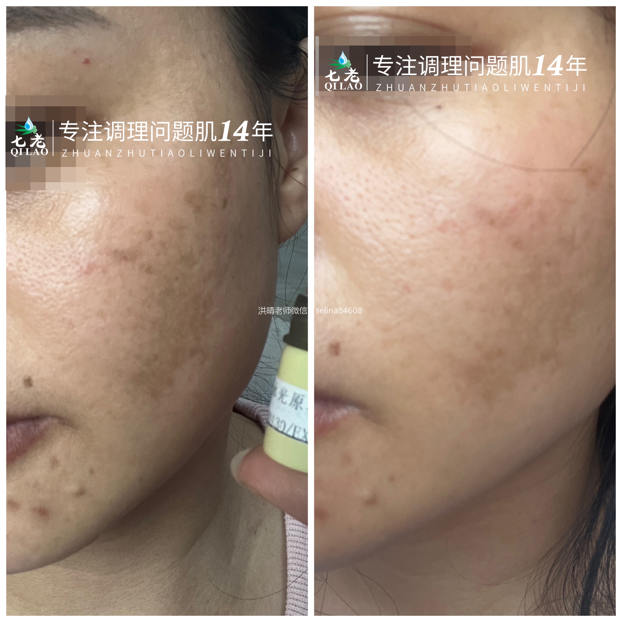 七老新品胶原水光→肌底修护，紧致抗衰于一体，让你皮肤胶原蛋白满满紧致白亮有光泽