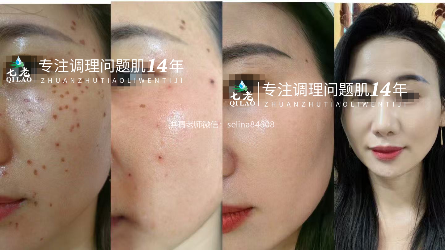 斑点敏感痘痘肌修护案例