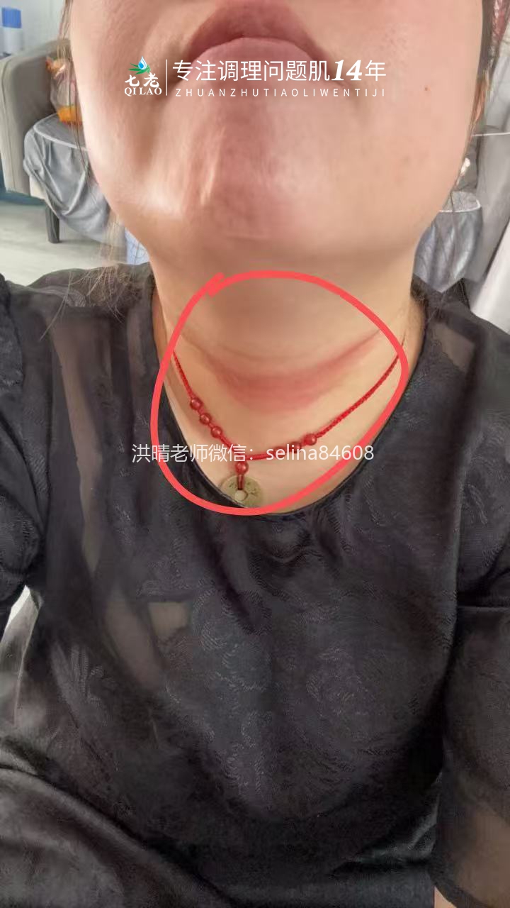 七老激素脸红肿痒反复过敏修护案例