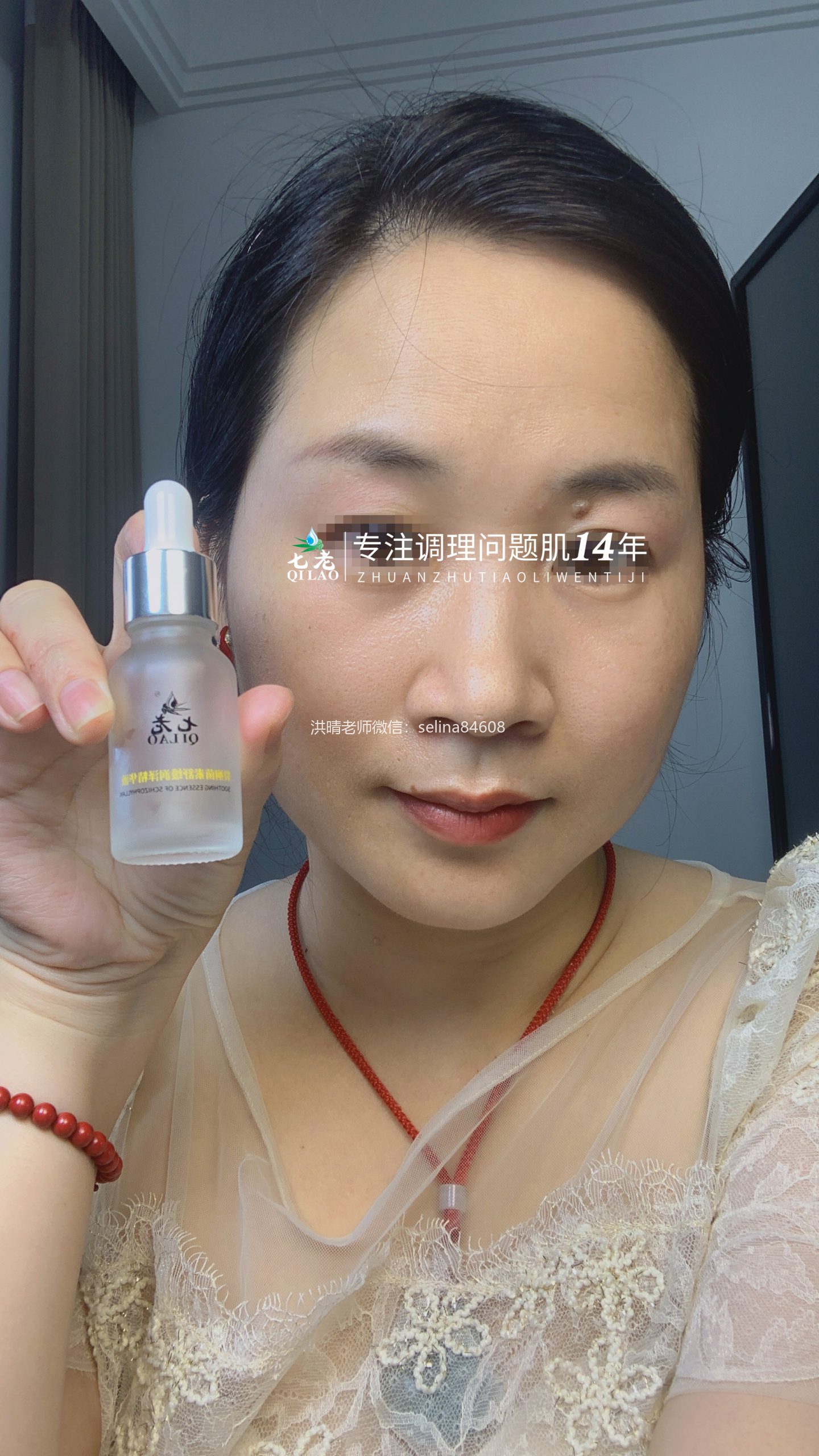 七老眼周反复过敏案例