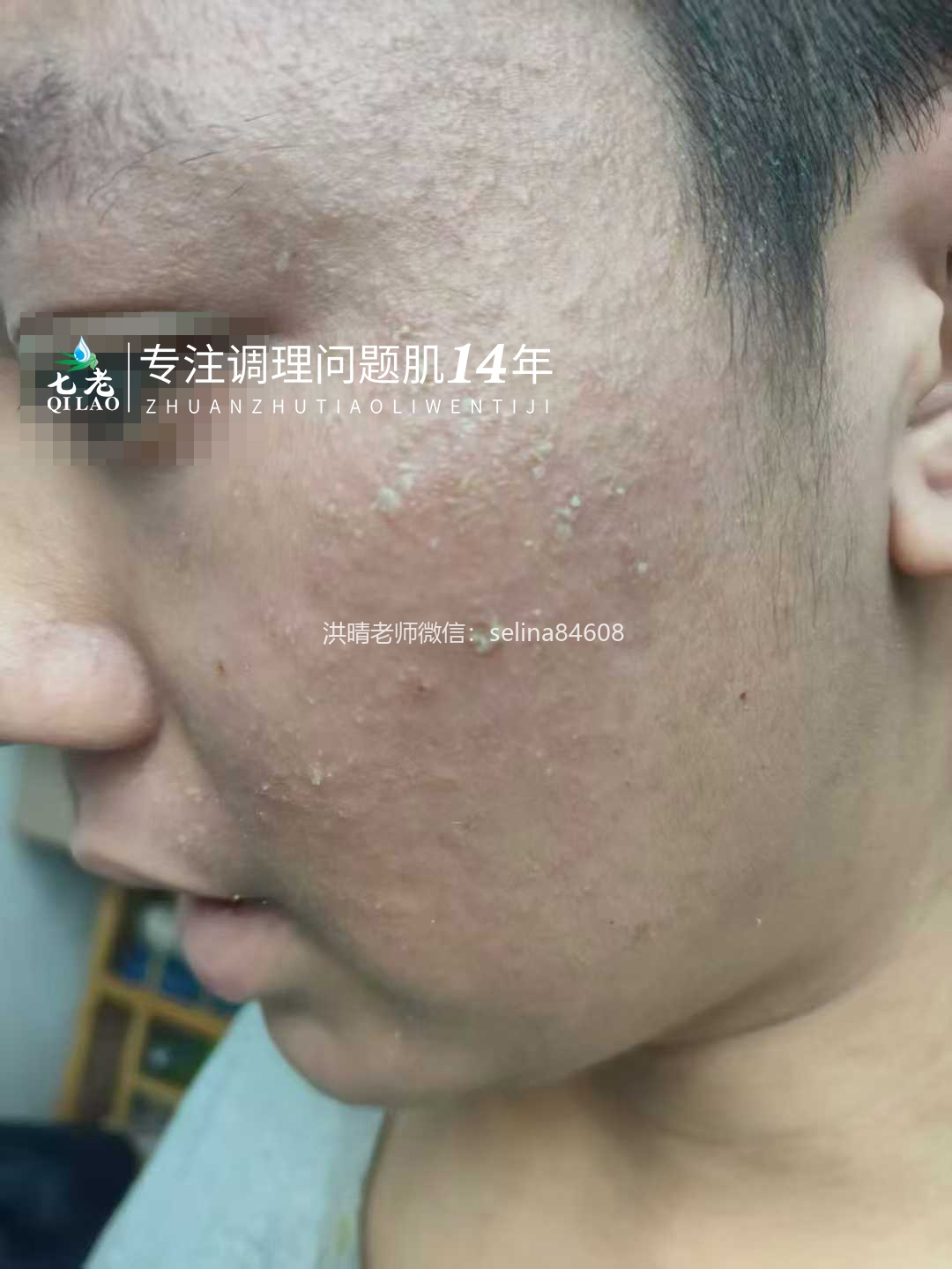 七老严重激素脸流黄水结痂渗液修护记录✍️